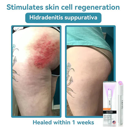 🔥First 100 :2nd ltem 60% Off🔥All-in-One CO₂ Laser Eraser Pen | Removes Moles, Warts, Skin Flaws & Pigmentation